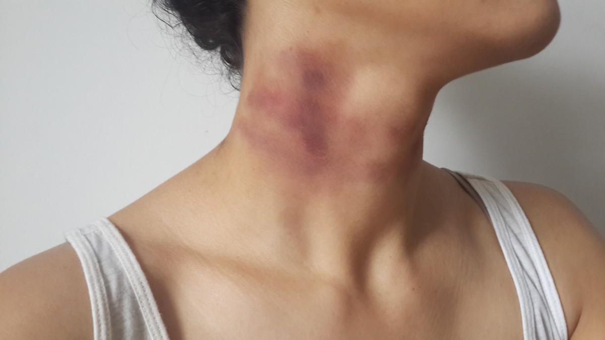 Waspada Purpura Simplex, Memar Biru Tiba-tiba Pada Tubuh